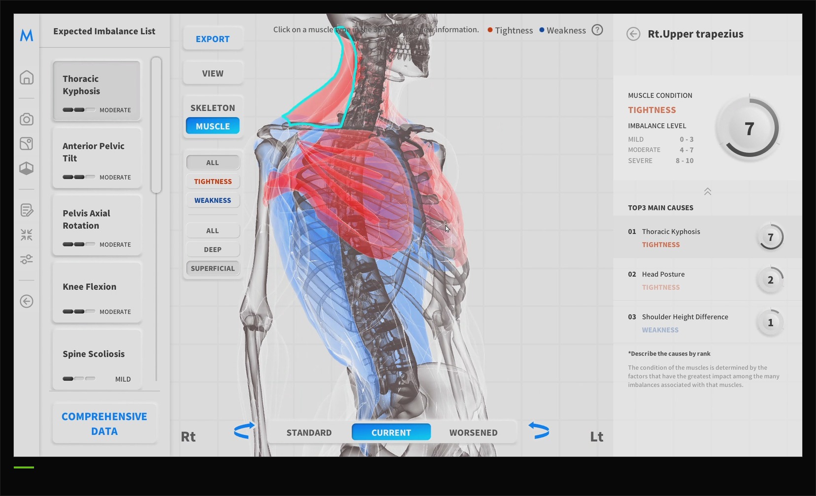 MOTI Physio muscle view report showing tightness and weakness readings for the right upper trapezius, with imbalance level and ranked causes